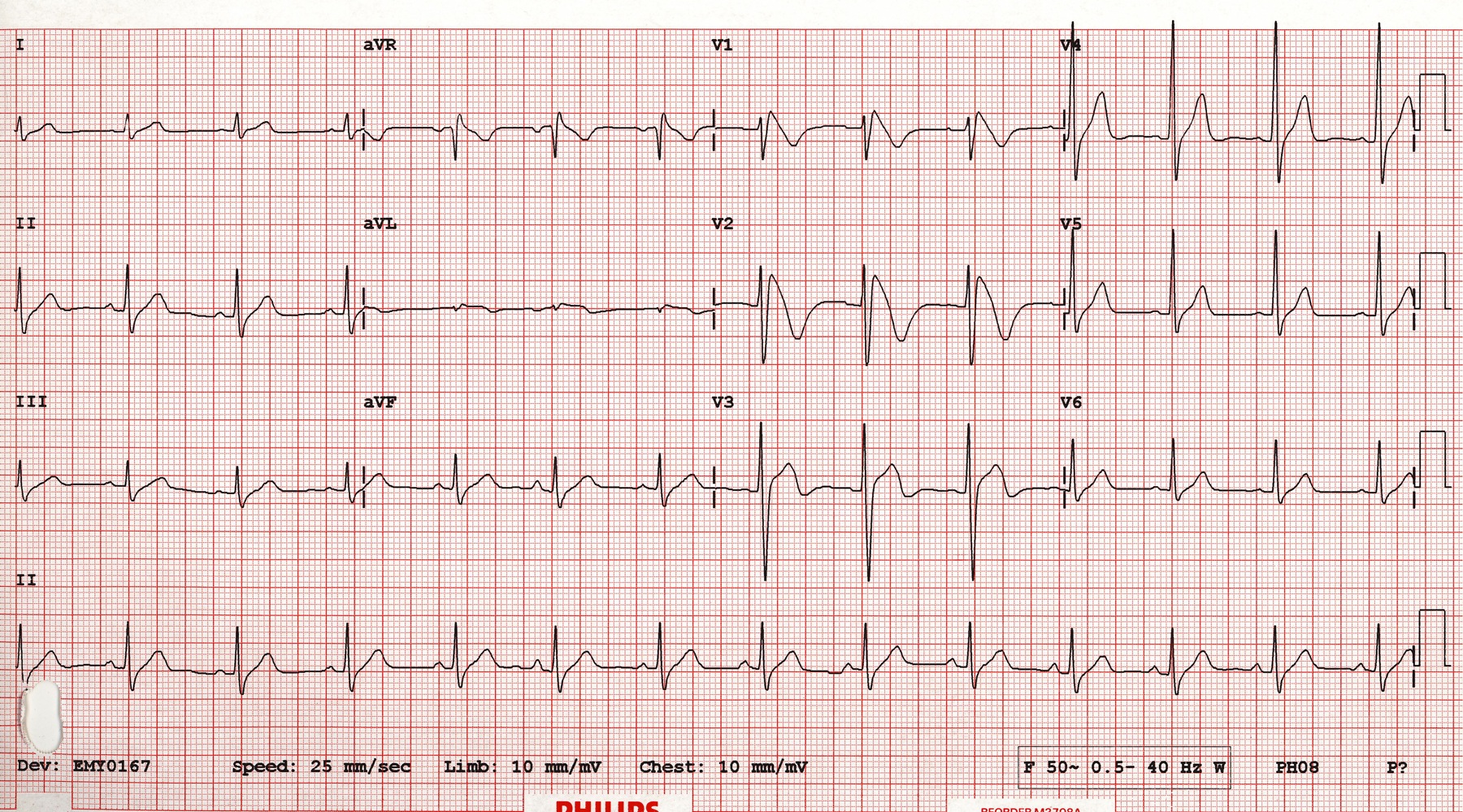 An example 12-lead ECG reading. Source: sujyotheartclinic.com